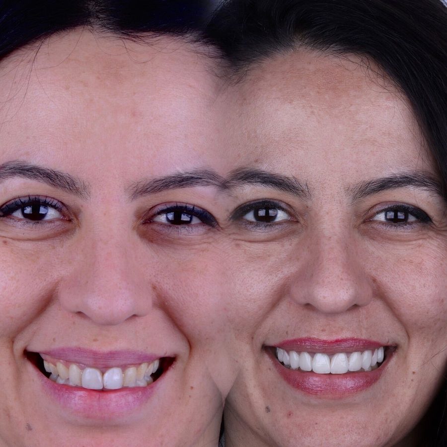 Carillas de porcelana en Málaga, transformación completa de la sonrisa (caso 15)