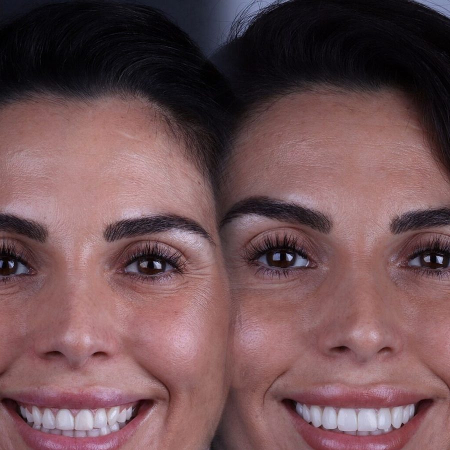 Carillas de composite en Málaga, antes y después (caso 22)