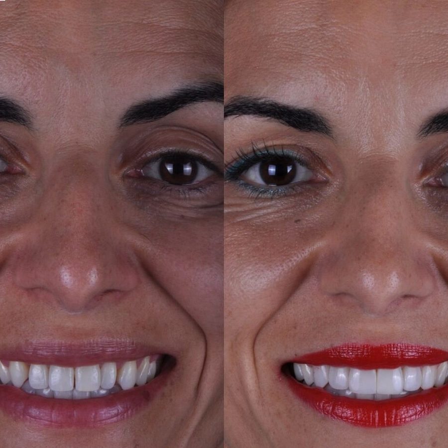 Carillas de composite en Málaga, resultado final (caso 7)