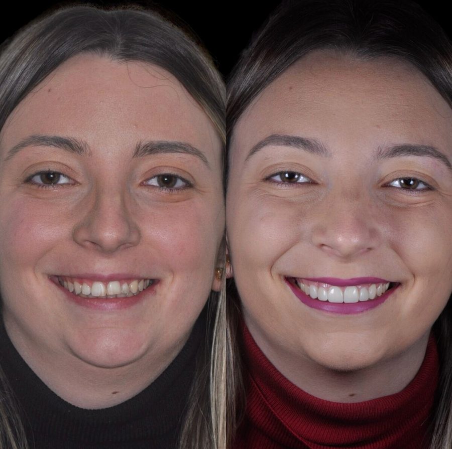 Carillas de composite en Málaga, antes y después (caso 3)