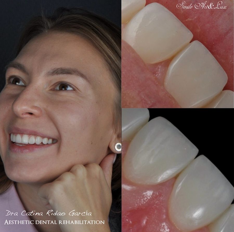 Carillas de composite en Málaga, transformación completa de la sonrisa (caso 4)