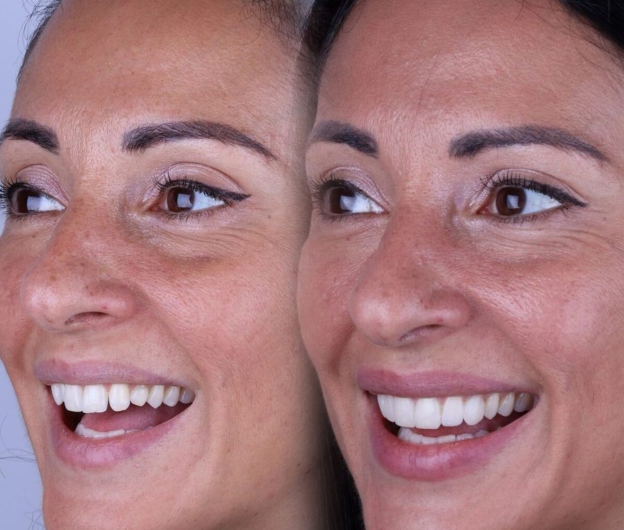 Carillas de composite en Málaga, transformación completa de la sonrisa (caso 8)