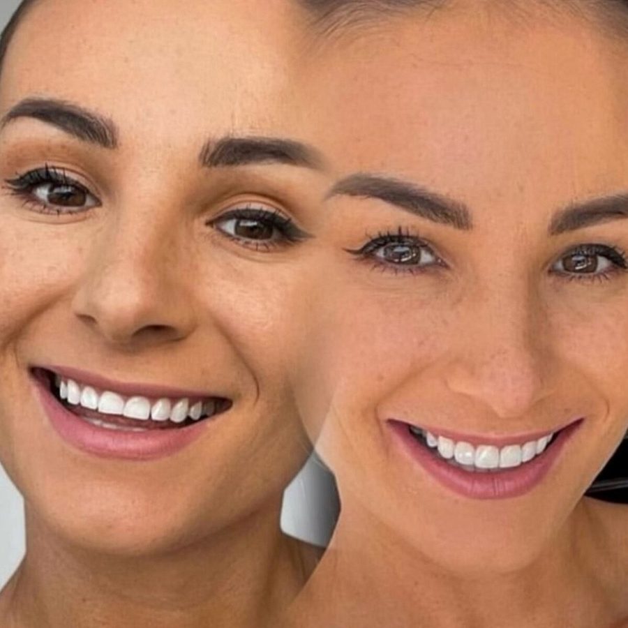 Carillas de composite en Málaga, transformación completa de la sonrisa (caso 5)