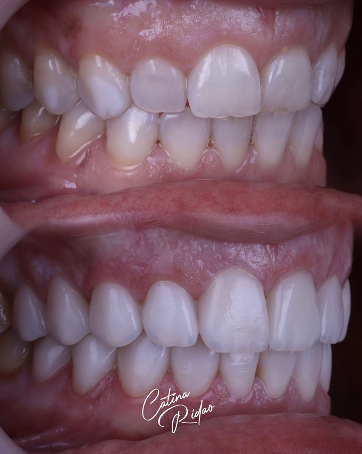 Carillas de cerámica antes y después, sonrisa frontal