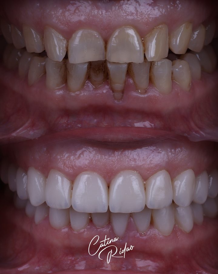 Carillas de cerámica antes y después, desgaste dental corregido