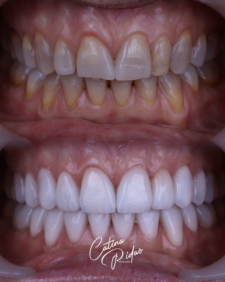 Carillas de cerámica antes y después, cambio de color y forma