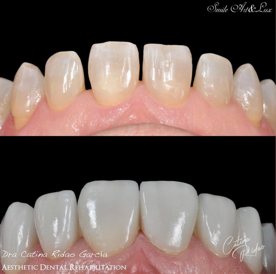 Carillas de cerámica antes y después, borde incisal