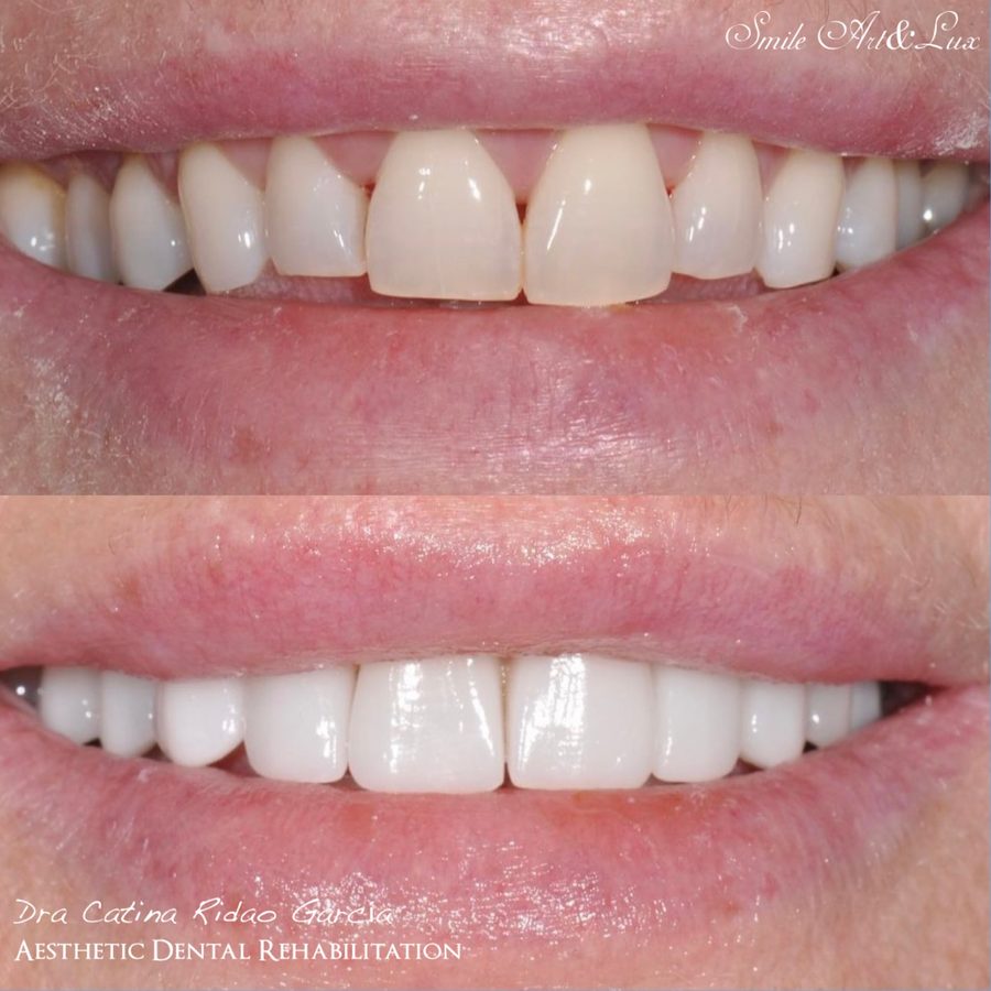 Carillas de cerámica antes y después, sonrisa natural
