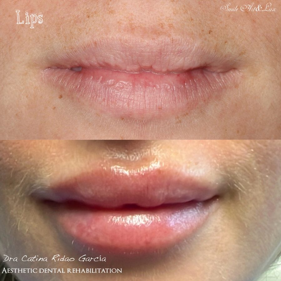 Ácido hialurónico en labios, antes y después