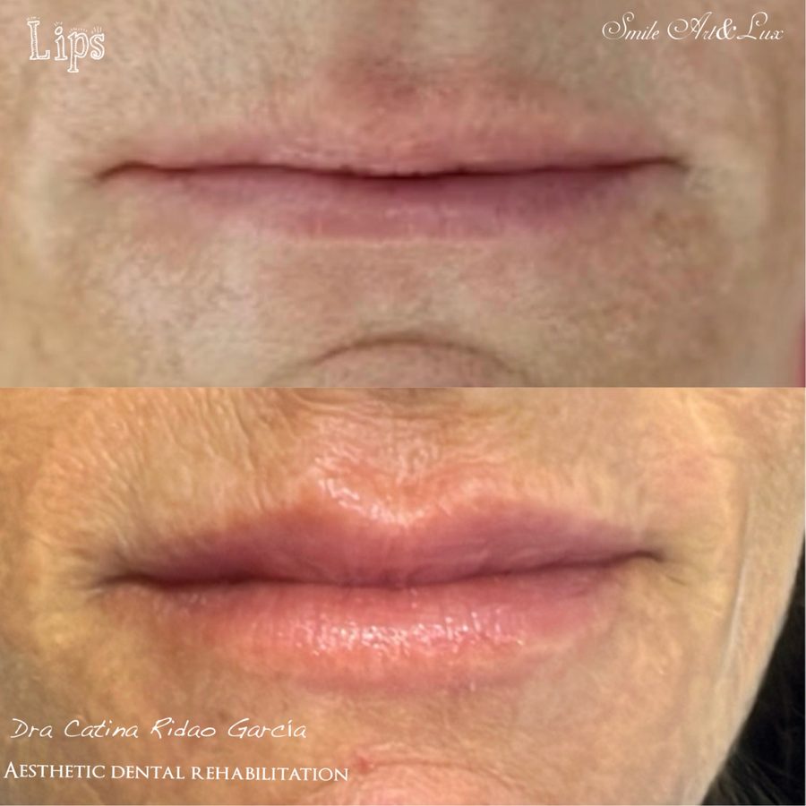 Relleno de labios con ácido hialurónico, antes y después