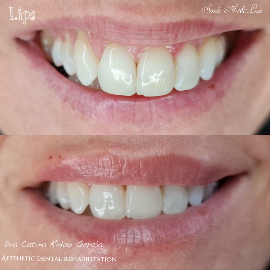 Perfilado de labios, antes y después con sonrisa