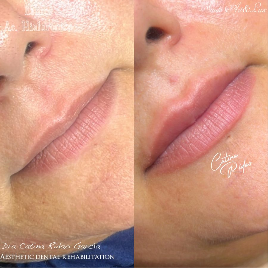 Aumento de labios natural, antes y después de perfil