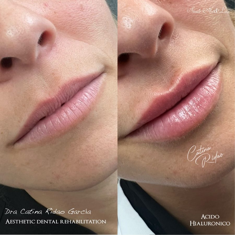 Ácido hialurónico labial, resultado natural antes y después