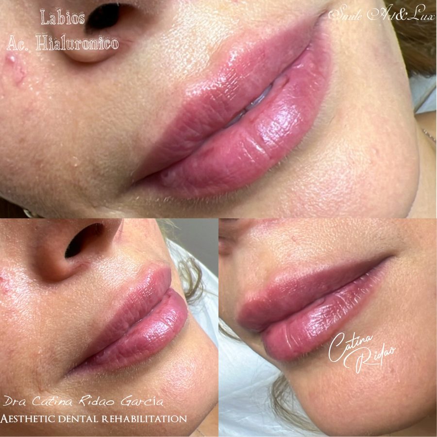 Perfilado y volumen labial, antes y después