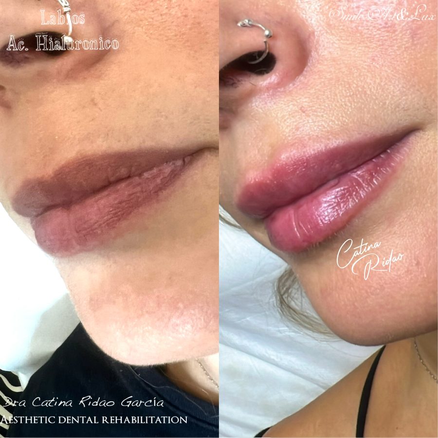 Relleno labial con ácido hialurónico, antes y después
