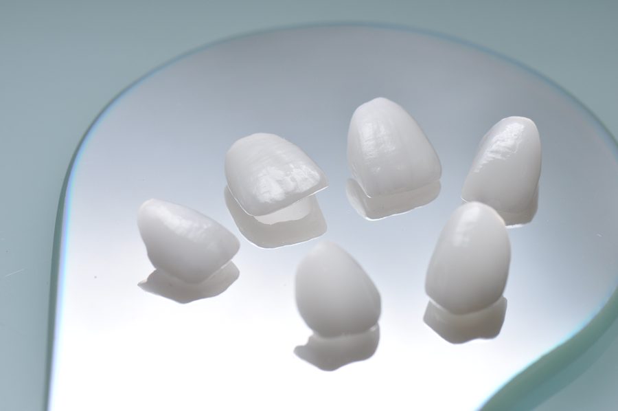 Carillas de porcelana terminadas en laboratorio