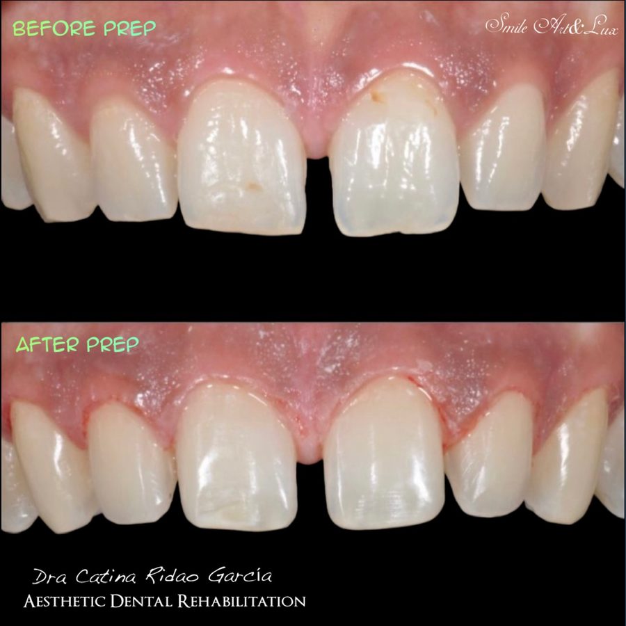 Dientes antes y después del tallado para carillas