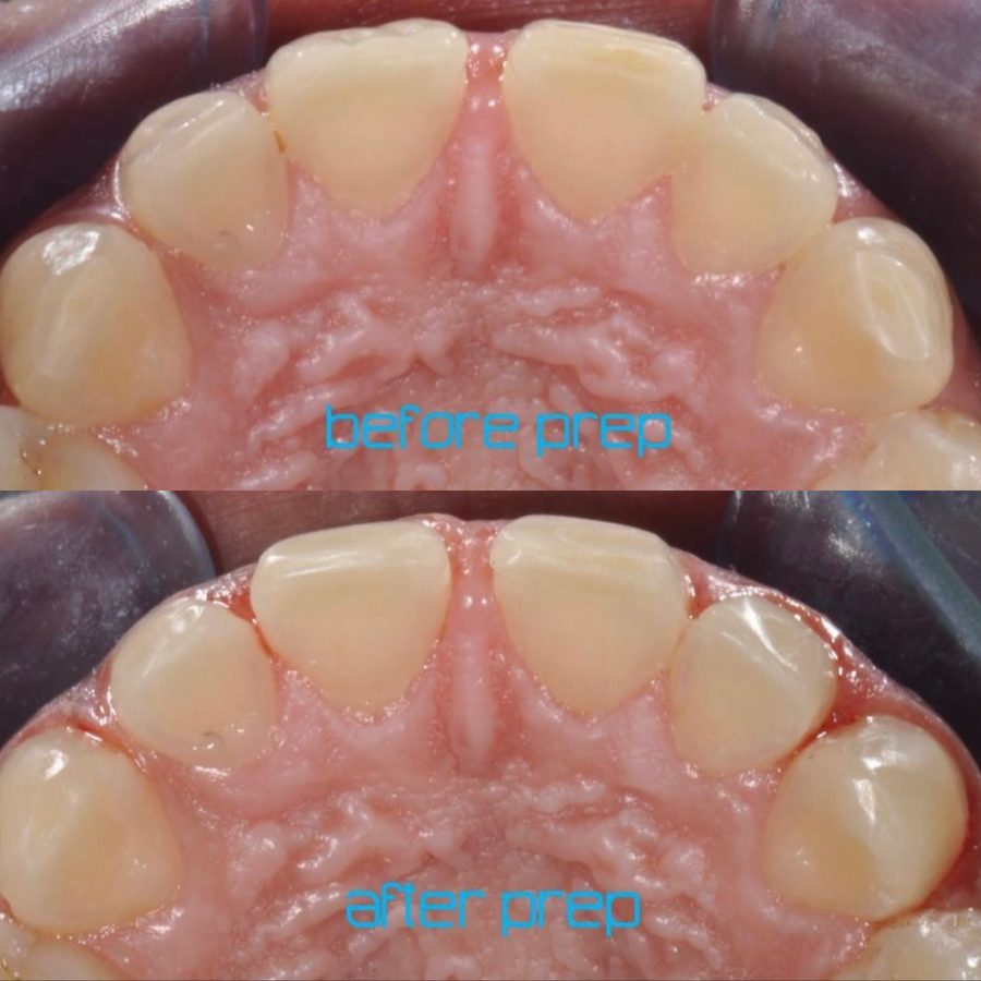 Vista oclusal antes y después de la preparación dental
