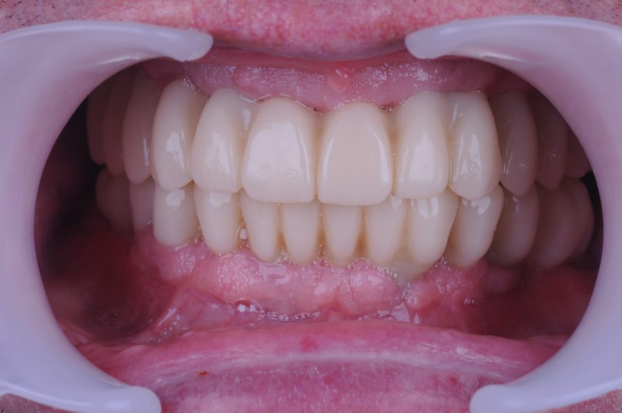 Rehabilitación completa sobre implantes, resultado frontal