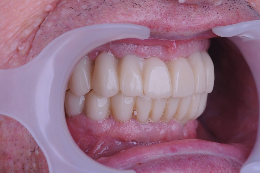 Prótesis fija sobre implantes, vista lateral