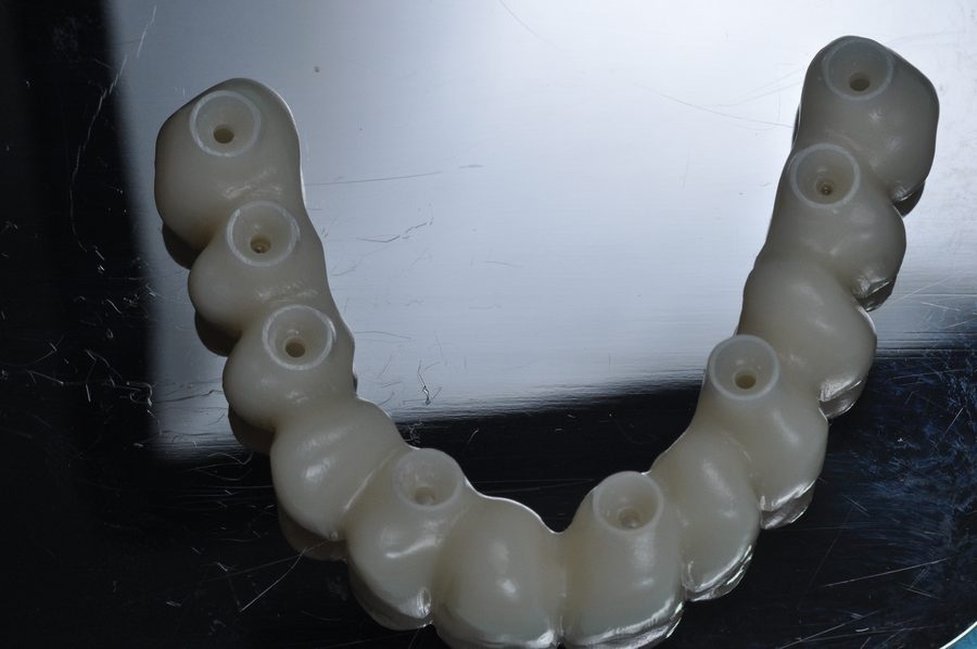 Prótesis de zirconio sobre implantes, vista lateral
