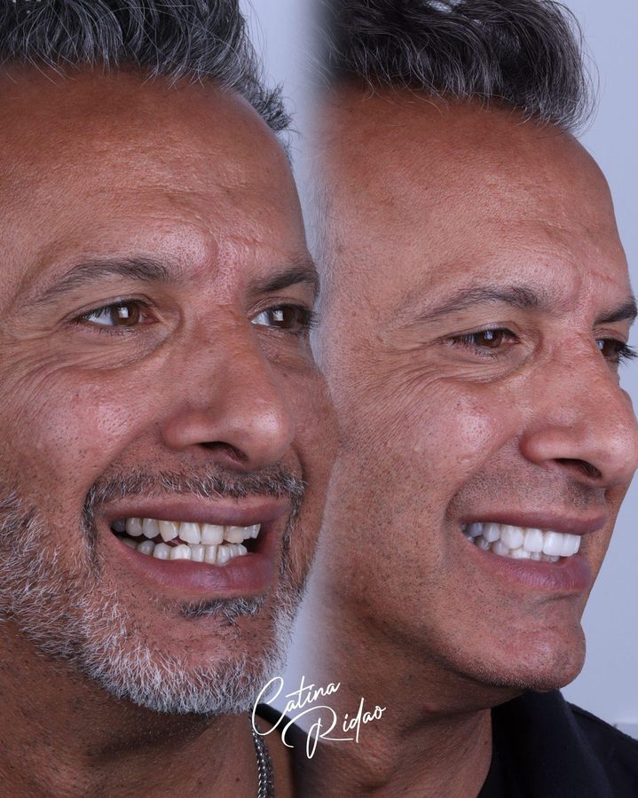 Diseño digital de sonrisa DSD en Málaga, simulación
